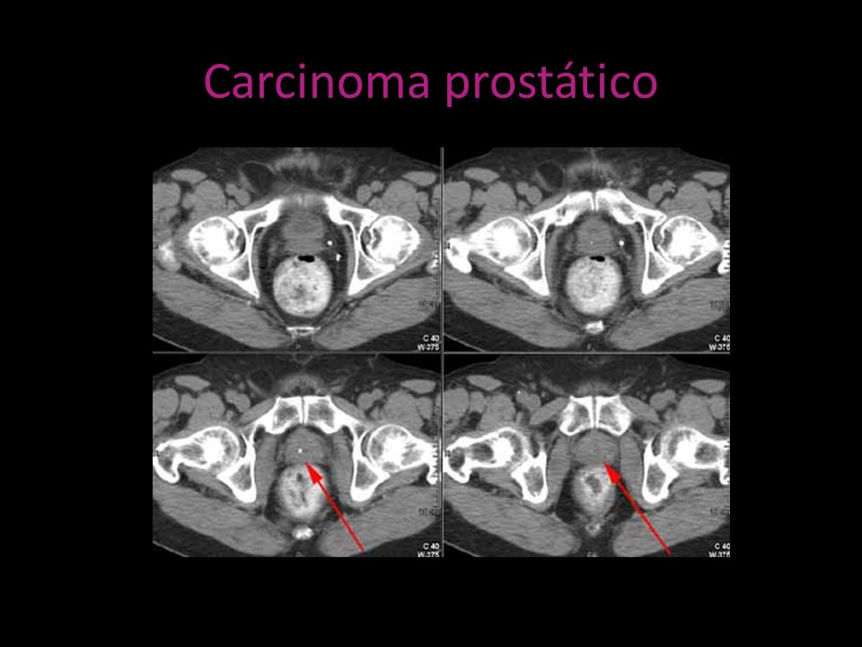 prostata diametro transverso 4 cm 2 prostata diametro transverso 4 cm 2